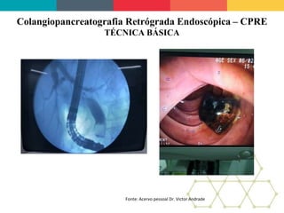 Colangiopancreatografia Retrógrada Endoscópica – CPRE
TÉCNICA BÁSICA
Fonte: Acervo pessoal Dr. Victor Andrade
 