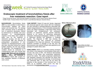 Copyright © 2016 Dr. Victor Andrade. E-mail: vaendoscopia@gmail.com
Thiago Ferreira de Souza; Victor Emanoel Gregório de Andrade; Vinícius Guerra Garcia; Mariana Souza
Varella Frazão; Tomazo Antônio Prince Franzini; Lucas Menezes Marques; Eduardo Grecco
BACKGROUND: Bronchobiliary fistula
(BBF) is a rare condition in which there is
communication between the biliary
system and bronchial tree. The etiology
most commonly found is secondary to
liver or subphrenic abscesses, infected
by echinococcus or amoeba. Can occur
secondary to transdiaphragmatic
migration of the biliary stent, placed on
biliary tract for the treatment of
obstructive jaundice, and also to liver
mucormycosis. BBF was observed as
postoperative complications of liver
resection for cholangiocarcinoma. It has
also been described arising from hepatic
hydatid migration into the lung through
the diaphragm. The management of this
condition should be conducted by a
multidisciplinary team and involves less
invasive alternatives such as endoscopic
therapy and transparietohepatic
drainage.
Endoscopic treatment of bronchobiliary fistula after
liver metastasis resection: Case report
OBJECTIVE: This study aims to report a
case of a patient who developed a
bronchobiliary fistula after surgery for
liver metastasis resection of advanced
colon cancer.
CASE REPORT: Patient 53 year-old, female, diagnosed
with advanced sigmoid colon cancer with liver metastasis
and was submited a rectosigmoidectomy associated with
hepatic trisegmentectomy. In the immediate postoperative
period, the patient developed a high-output biliary fistula
associated with choleperitoneum and subsequent
formation of subphrenic abscess drained externally.
Referred to our service for performing endoscopic
retrograde cholangiopancreatography (ERCP) by default
of obstructive jaundice and bilioptysis in moderate
quantity. The diagnosis of BBF was showing the
cholangiography and then confirmed by computed
tomography of the chest and abdomen. The endoscopic
treatment consisted of drainage of the bile duct; the
decompression was realized through wide papillotomy and
passage of a plastic biliary stent.
CONCLUSION: ERCP is a minimally invasive procedure
and choice in the treatment of bronchobiliary fistula with a
success rate close to 60%. The literature demonstrates
resolution of the fistula, with conservative treatments,
around five weeks. The patient progressed satisfactorily
with bilioptysis resolution and decrease the bilious flow
through the external abdominal drainage. A bronchoscopy
was performed after 15 days and did not show the
presence of bile secretion in the bronchial tree. In the
follow up of outpatient, didn't occurs any sign of
recurrence of the bronchobiliary fistula.
 