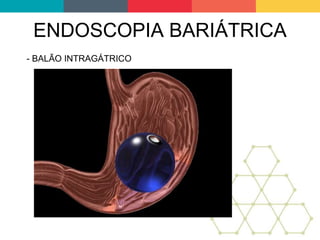 ENDOSCOPIA BARIÁTRICA
- BALÃO INTRAGÁTRICO
 