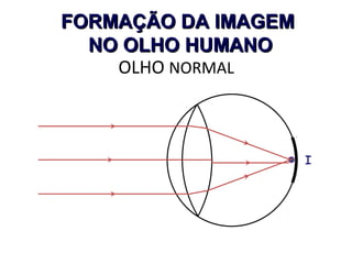 FORMAÇÃO DA IMAGEM
NO OLHO HUMANO
OLHO NORMAL

I

 
