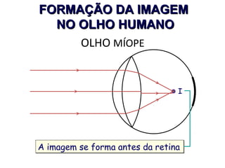 FORMAÇÃO DA IMAGEM
NO OLHO HUMANO
OLHO MÍOPE

I

A imagem se forma antes da retina

 