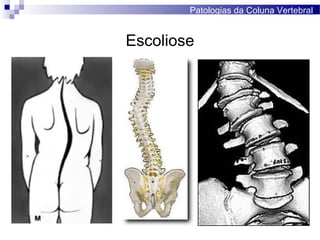 Escoliose
Patologias da Coluna Vertebral
 