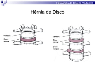 Hérnia de Disco
Patologias da Coluna Vertebral
 