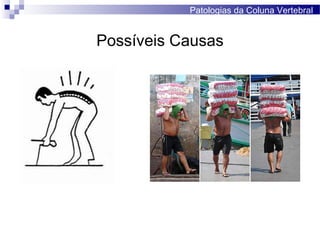 Possíveis Causas
Patologias da Coluna Vertebral
 