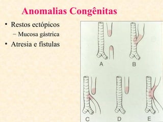 Anomalias Congênitas
• Restos ectópicos
  – Mucosa gástrica
• Atresia e fístulas
 
