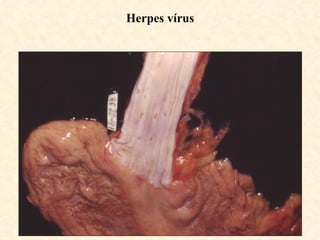 Herpes vírus
 
