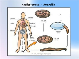 Ancilostomose - Amarelão
 
