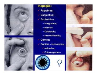 Inspeção:
 Pálpebras;
 Conjuntiva;
 Esclerótica:
    integridade;
    edemas;
    Coloração;
    vascularização;
 Córnea;
 Pupilas - isocoricas;
    redondas;
    Fotoreagentes -
 