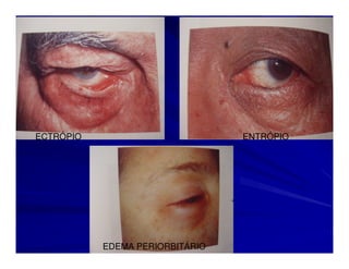 ECTRÓPIO                         ENTRÓPIO




           EDEMA PERIORBITÁRIO
 