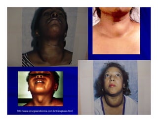 http://www.cirurgiaendocrina.com.br/tireoglosso.html
 
