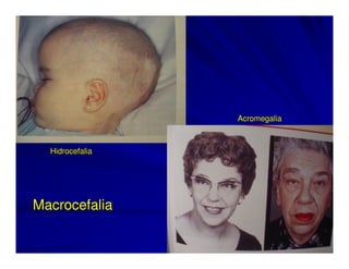 Acromegalia



  Hidrocefalia




Macrocefalia
 