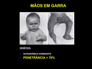 MÃOS EM GARRA




GENÉTICA:

   AUTOSSÔMICA DOMINANTE

 PENETRÂNCIA = 70%
 