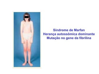 Síndrome de Marfan
Herança autossômica dominante
  Mutação no gene da fibrilina
 
