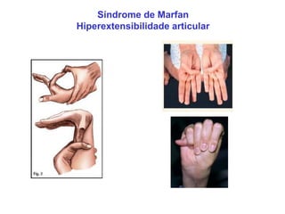 Síndrome de Marfan
Hiperextensibilidade articular
 