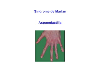Síndrome de Marfan


  Aracnodactilia
 
