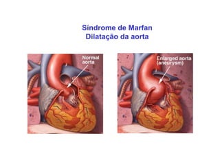 Síndrome de Marfan
 Dilatação da aorta
 