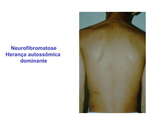 Neurofibromatose
Herança autossômica
     dominante
 