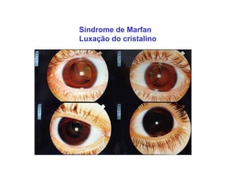 Síndrome de Marfan
Luxação do cristalino
 