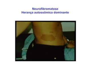 Neurofibromatose
Herança autossômica dominante
 