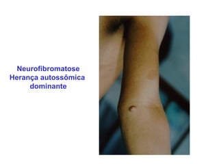 Neurofibromatose
Herança autossômica
     dominante
 