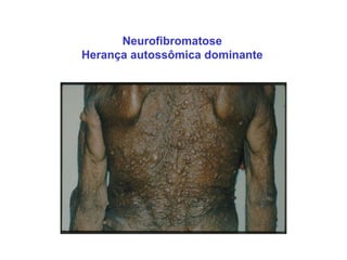 Neurofibromatose
Herança autossômica dominante
 