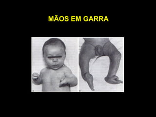 MÃOS EM GARRA
 