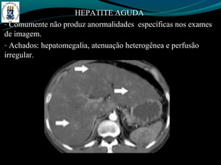HEPATITE AGUDA
- Comumente não produz anormalidades específicas nos exames
de imagem.
- Achados: hepatomegalia, atenuação heterogênea e perfusão
irregular.
 