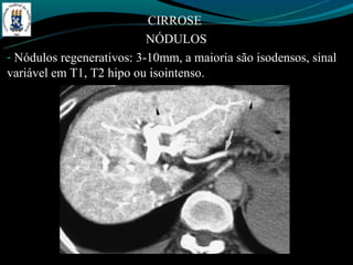 CIRROSE
                           NÓDULOS
- Nódulos regenerativos: 3-10mm, a maioria são isodensos, sinal
variável em T1, T2 hipo ou isointenso.
 