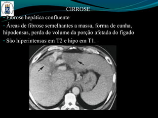 CIRROSE
- Fibrose hepática confluente
- Áreas de fibrose semelhantes a massa, forma de cunha,
hipodensas, perda de volume da porção afetada do fígado
- São hiperintensas em T2 e hipo em T1.
 