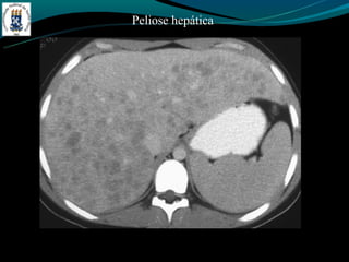 Peliose hepática
 