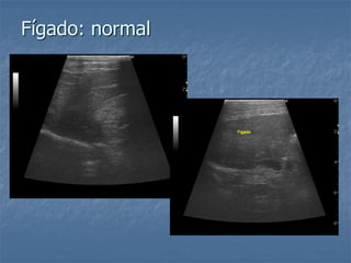 Fígado: normal
 