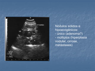 Nódulos sólidos e
hipoecogênicos:
- único (adenoma?)
- múltiplos (hiperplasia
nodular, cirrose,
metástases)
 