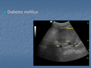  Diabetes mellitus
 