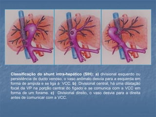 Classificação do shunt intra-hepático (SIH): a) divisional esquerdo ou
persistência de ducto venoso, o vaso anômalo desvia para a esquerda em
forma de ampola e se liga à VCC. b) Divisional central, há uma dilatação
focal da VP na porção central do fígado e se comunica com a VCC em
forma de um forame. c) Divisional direito, o vaso desvia para a direita
antes de comunicar com a VCC.
 