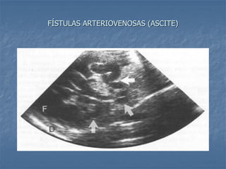 FÍSTULAS ARTERIOVENOSAS (ASCITE)
 