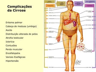 Complicações
da Cirrose
Eritema palmar
Cabeça de medusa (umbigo)
Ascite
Distribuição alterada de pelos
Atrofia testicular
Icterícia
Contusões
Perda muscular
Encefalopatia
Varizes Esofágicas
Hipertensão
 