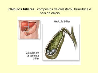 Cálculos biliares: compostos de colesterol, bilirrubina e
sais de cálcio
 