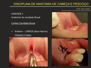 DISCIPLINA DE ANATOMIA DE CABEÇA E PESCOÇO
Prof: Tony Carlos
UNIDADE I:
Anatomia da cavidade Bucal
Limites Cavidade Bucal
 Anterior – LÁBIOS (face interna)
FRENECTOMIA
 