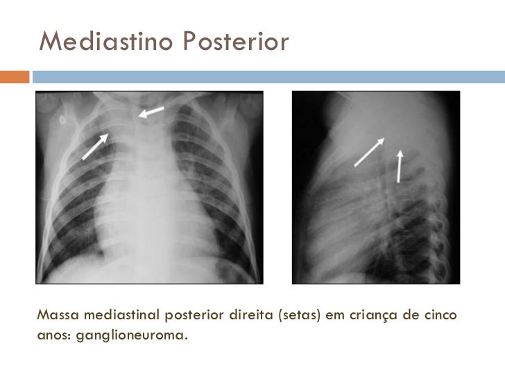 Radiologia torácica Hilos pulmonares e Doenças do Mediastino