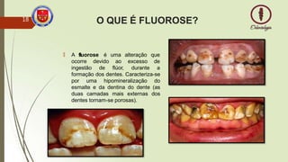 O QUE É FLUOROSE?
🠶 A fluorose é uma alteração que
ocorre
ingestão
devido
de
ao
flúor,
excesso de
durante a
formação dos dentes. Caracteriza-se
por uma hipomineralização do
esmalte e da dentina do dente (as
duas camadas mais externas dos
dentes tornam-se porosas).
18
 