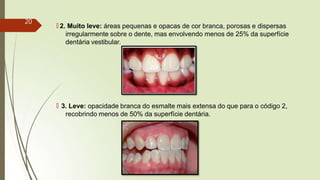 🠶 2. Muito leve: áreas pequenas e opacas de cor branca, porosas e dispersas
irregularmente sobre o dente, mas envolvendo menos de 25% da superfície
dentária vestibular.
🠶 3. Leve: opacidade branca do esmalte mais extensa do que para o código 2,
recobrindo menos de 50% da superfície dentária.
20
 