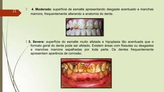 🠶 4. Moderada: superfície de esmalte apresentando desgaste acentuado e manchas
marrons, frequentemente alterando a anatomia do dente.
🠶 5. Severa: superfície do esmalte muito afetada e hipoplasia tão acentuada que o
formato geral do dente pode ser afetado. Existem áreas com fóssulas ou desgastes
e manchas marrons espalhadas por toda parte. Os dentes frequentemente
apresentam aparência de corrosão.
21
 