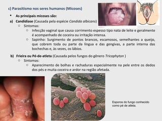 c) Parasitismo nos seres humanos (Micoses)
 As principais micoses são:
a) Candidíase (Causada pela espécie Candida albicans)
o Sintomas:
o Infecção vaginal que causa corrimento espesso tipo nata de leite e geralmente
é acompanhado de coceira ou irritação intensa.
o Sapinho: Surgimento de pontos brancos, escamosos, semelhantes a queijo,
que cobrem toda ou parte da língua e das gengivas, a parte interna das
bochechas e, às vezes, os lábios.
b) Frieira ou Pé-de-atleta (Causada pelos fungos do gênero Tricophyton )
o Sintomas:
o Aparecimento de bolhas e rachaduras especialmente na pele entre os dedos
dos pés e muita coceira e ardor na região afetada.
Esporos do fungo conhecido
como pé de atleta.
 