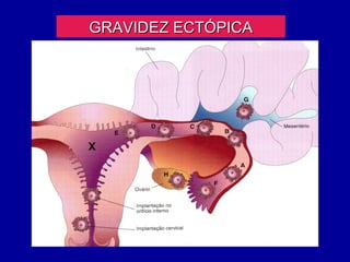 GRAVIDEZ ECTÓPICA
 