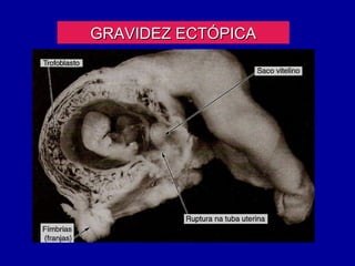 GRAVIDEZ ECTÓPICA
 