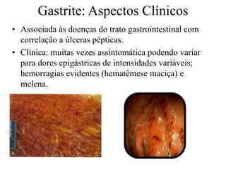 • Associada às doenças do trato gastrointestinal com
correlação a úlceras pépticas.
• Clínica: muitas vezes assintomática podendo variar
para dores epigástricas de intensidades variáveis;
hemorragias evidentes (hematêmese maciça) e
melena.
Gastrite: Aspectos Clínicos
 