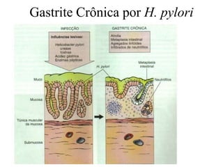 Gastrite Crônica por H. pylori
 