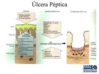 Úlcera Péptica
 