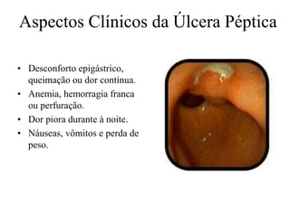 • Desconforto epigástrico,
queimação ou dor contínua.
• Anemia, hemorragia franca
ou perfuração.
• Dor piora durante à noite.
• Náuseas, vômitos e perda de
peso.
Aspectos Clínicos da Úlcera Péptica
 