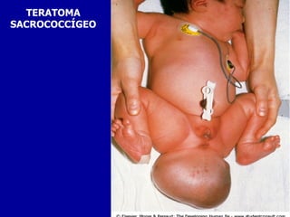 TERATOMA
SACROCOCCÍGEO
 